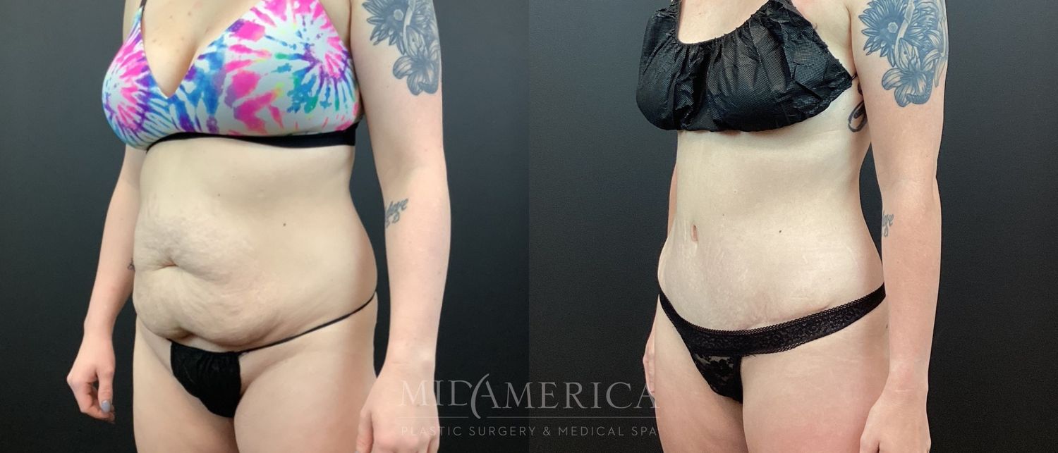 Tummy Tuck Before & After