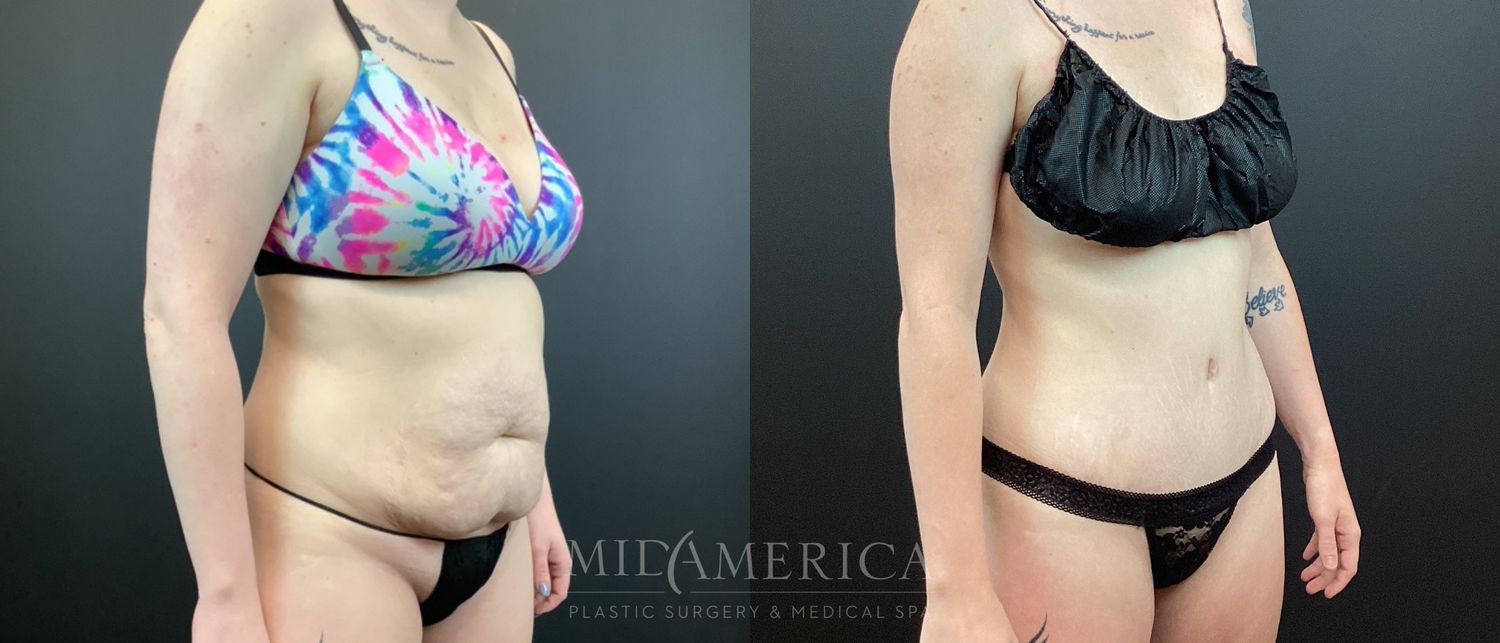Tummy Tuck Before & After