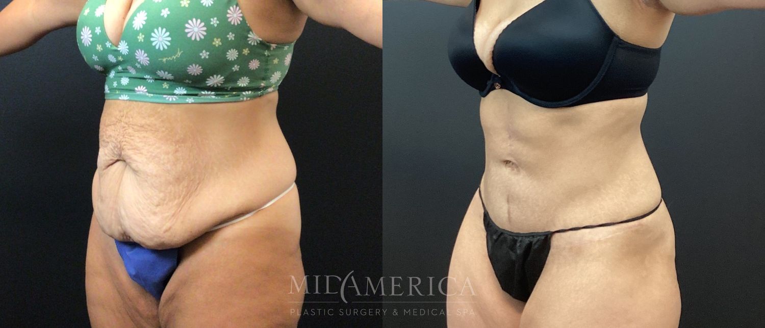 Tummy Tuck Before & After
