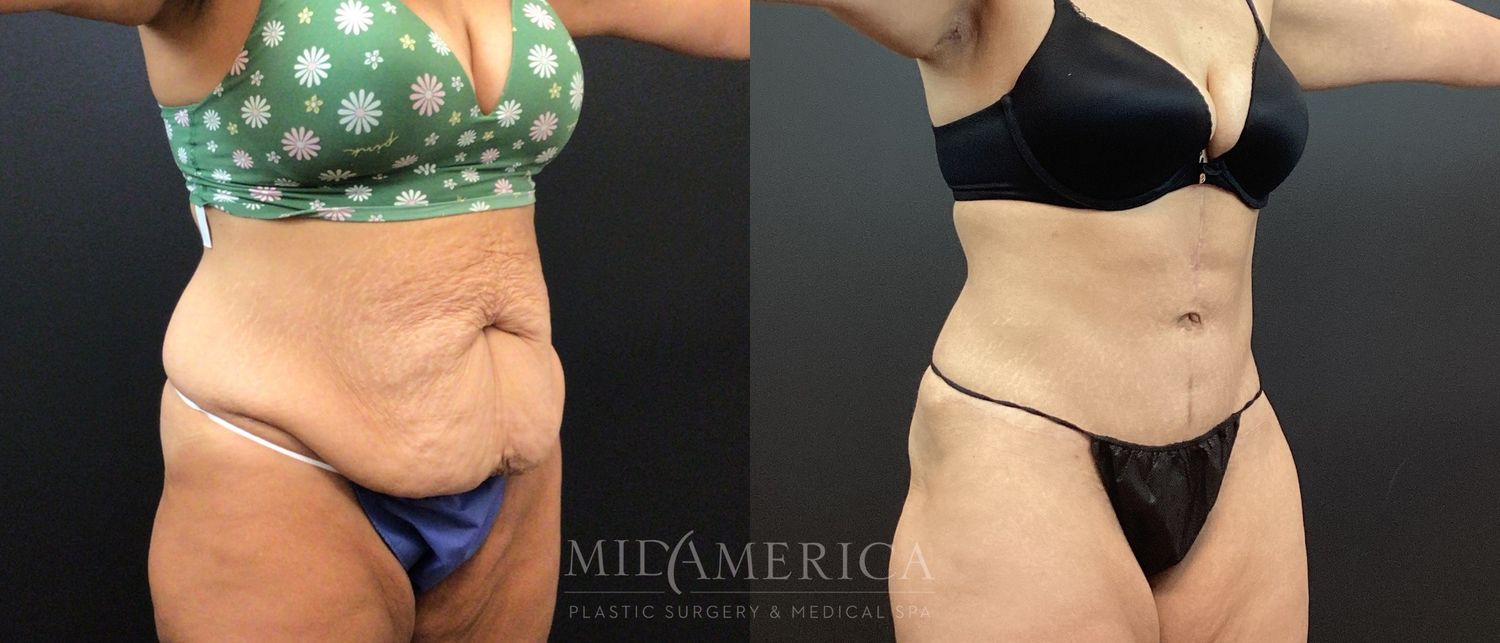 Tummy Tuck Before & After