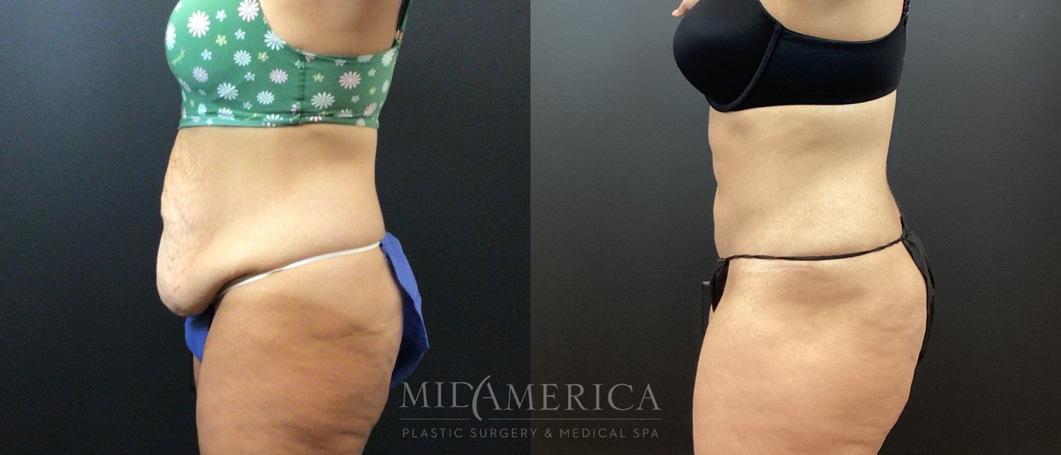 Tummy Tuck Before & After