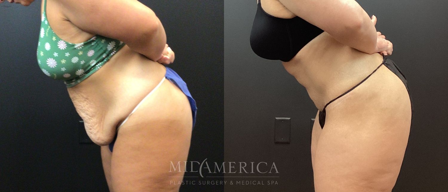 Tummy Tuck Before & After