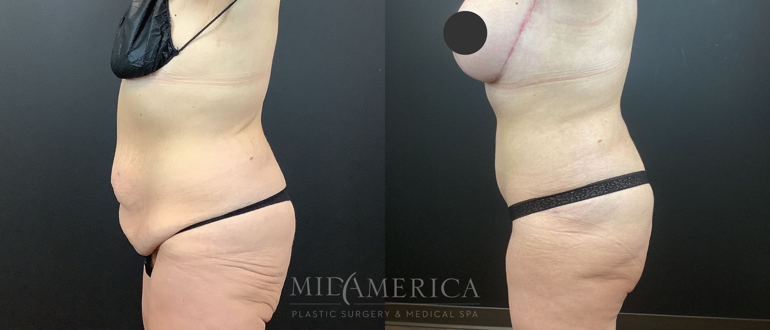 Tummy Tuck Before & After