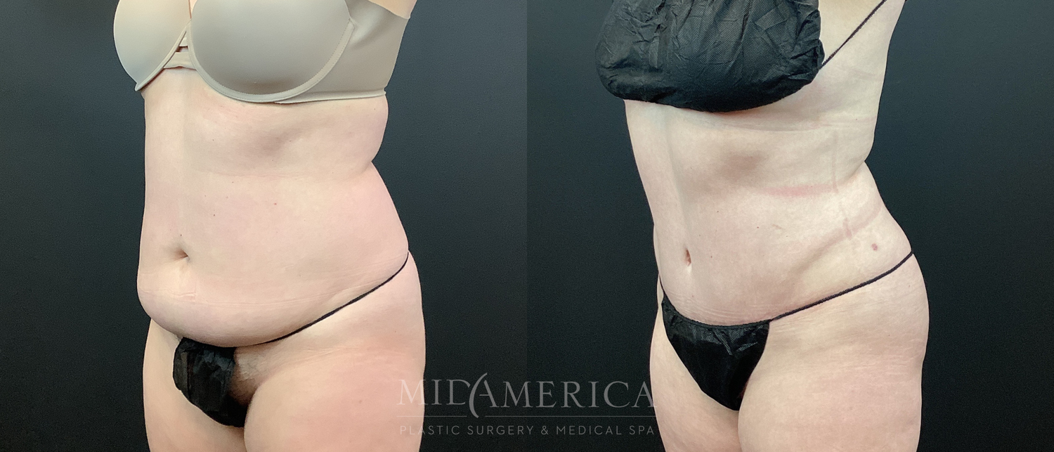 Tummy Tuck Before & After