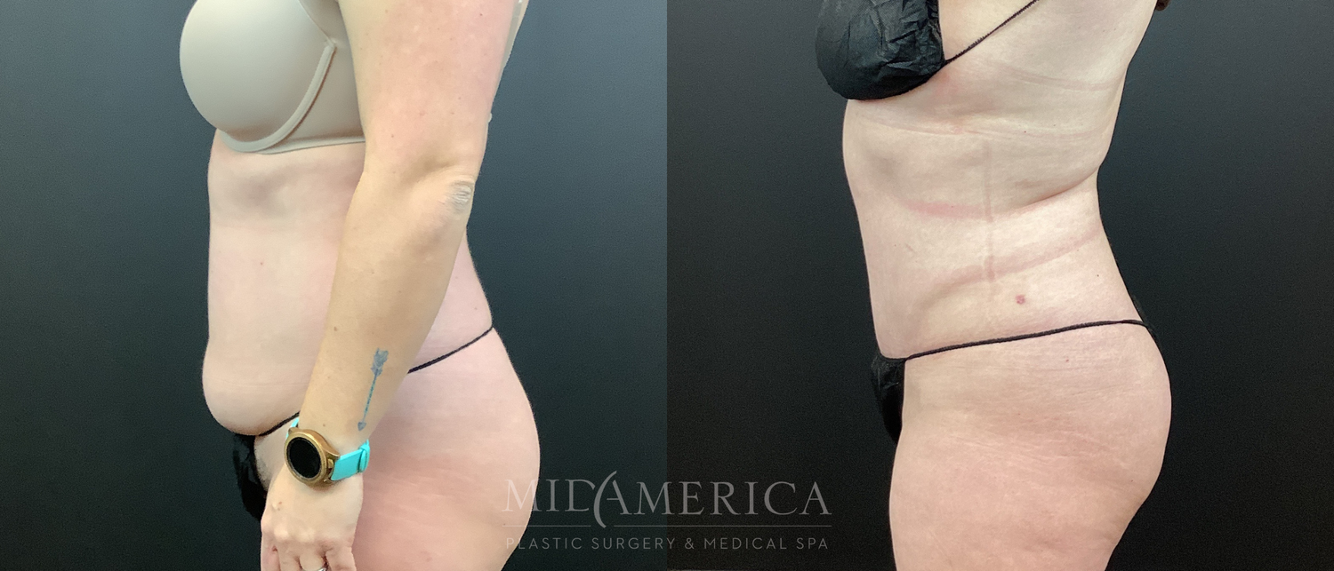 Tummy Tuck Before & After