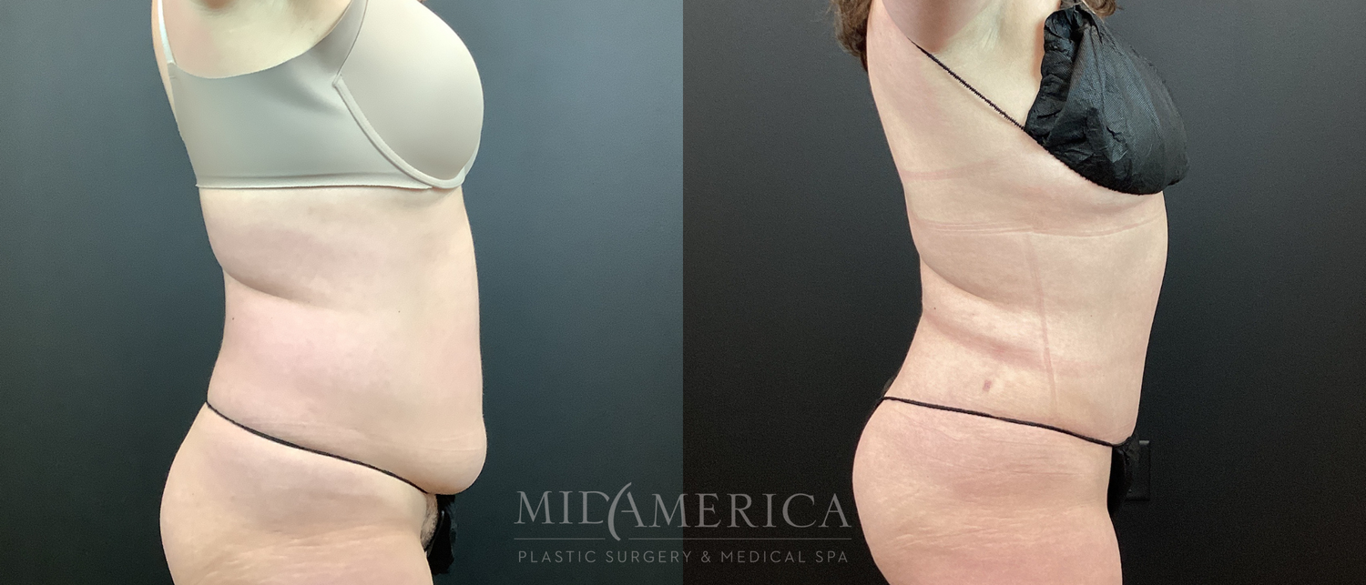 Tummy Tuck Before & After