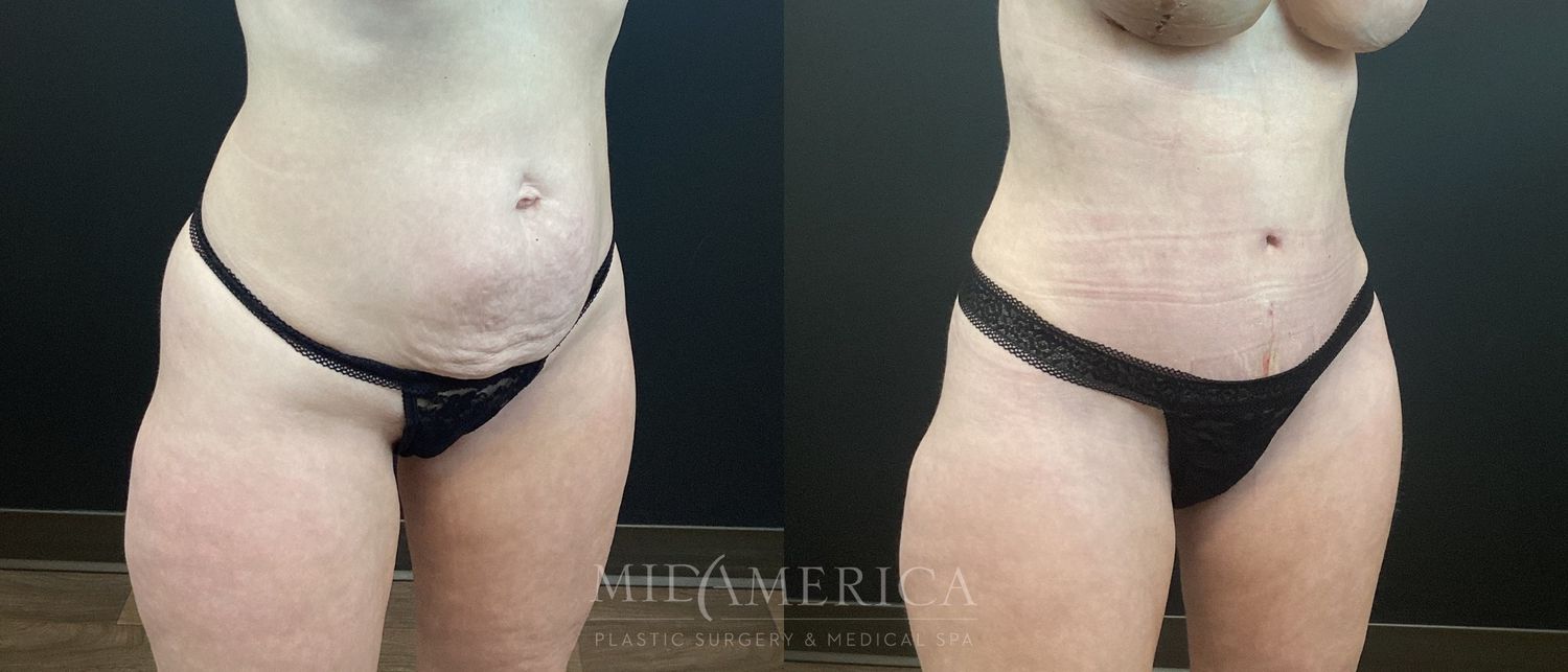 Tummy Tuck Before & After