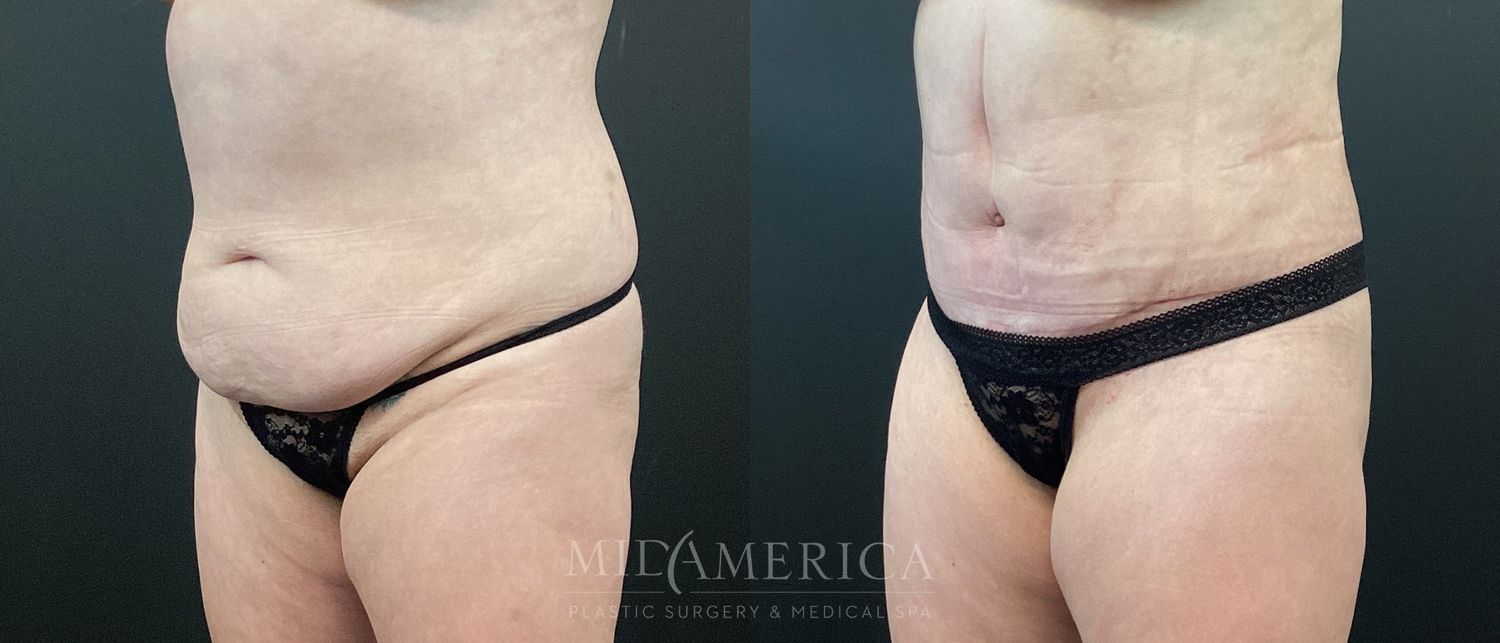 Tummy Tuck Before & After