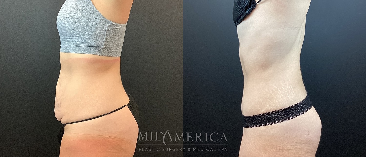 Tummy Tuck Before & After