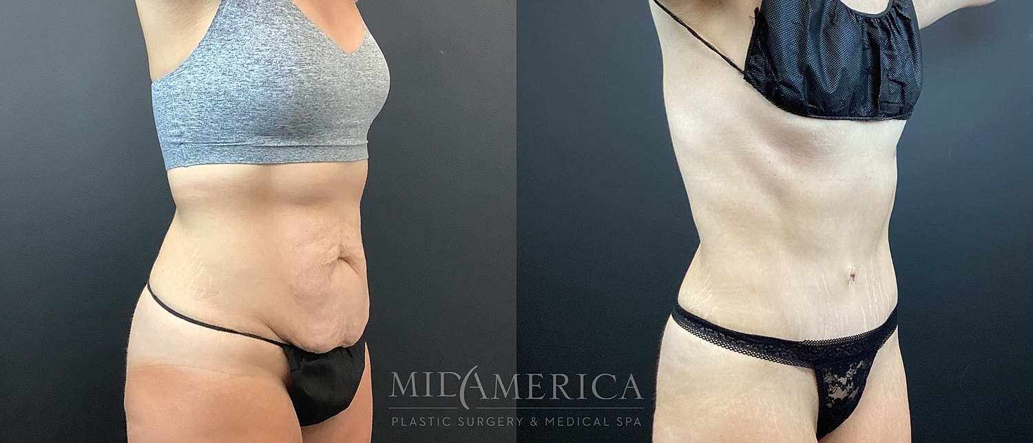 Tummy Tuck Before & After