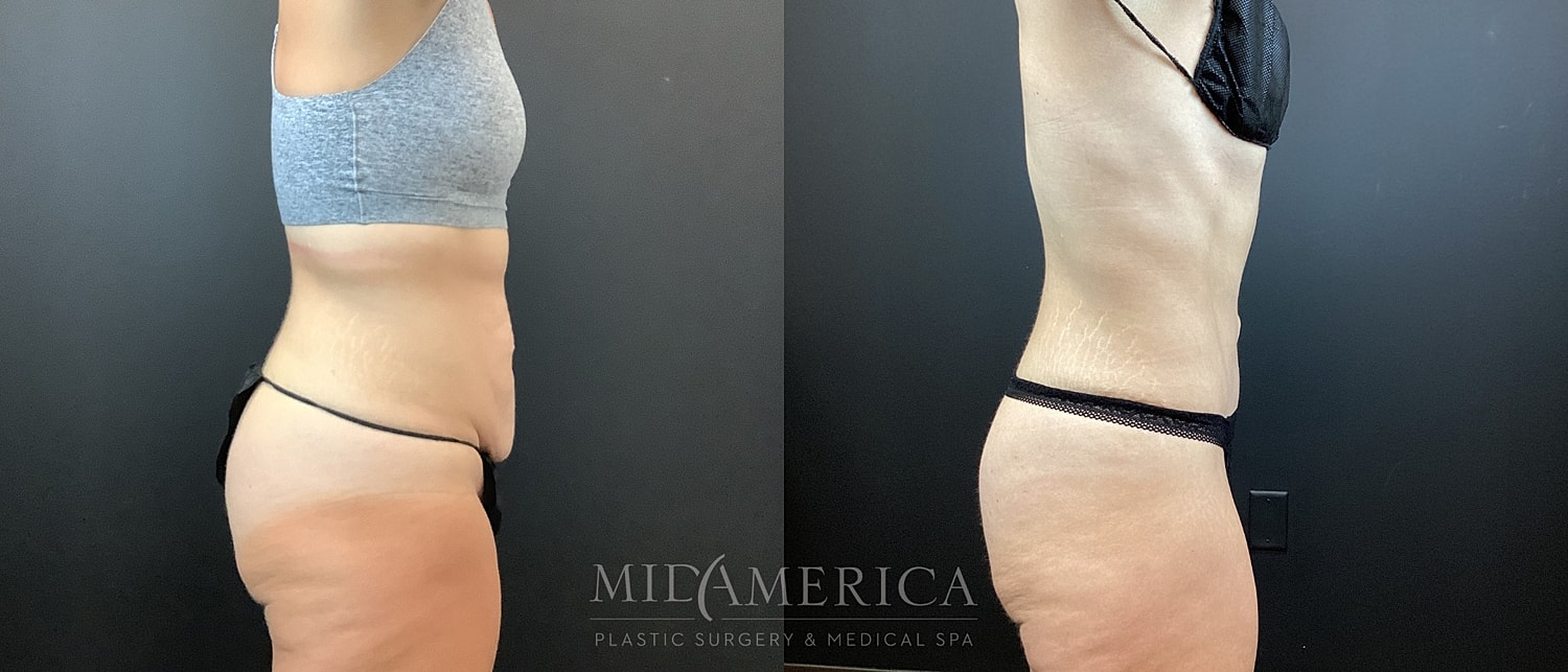 Tummy Tuck Before & After