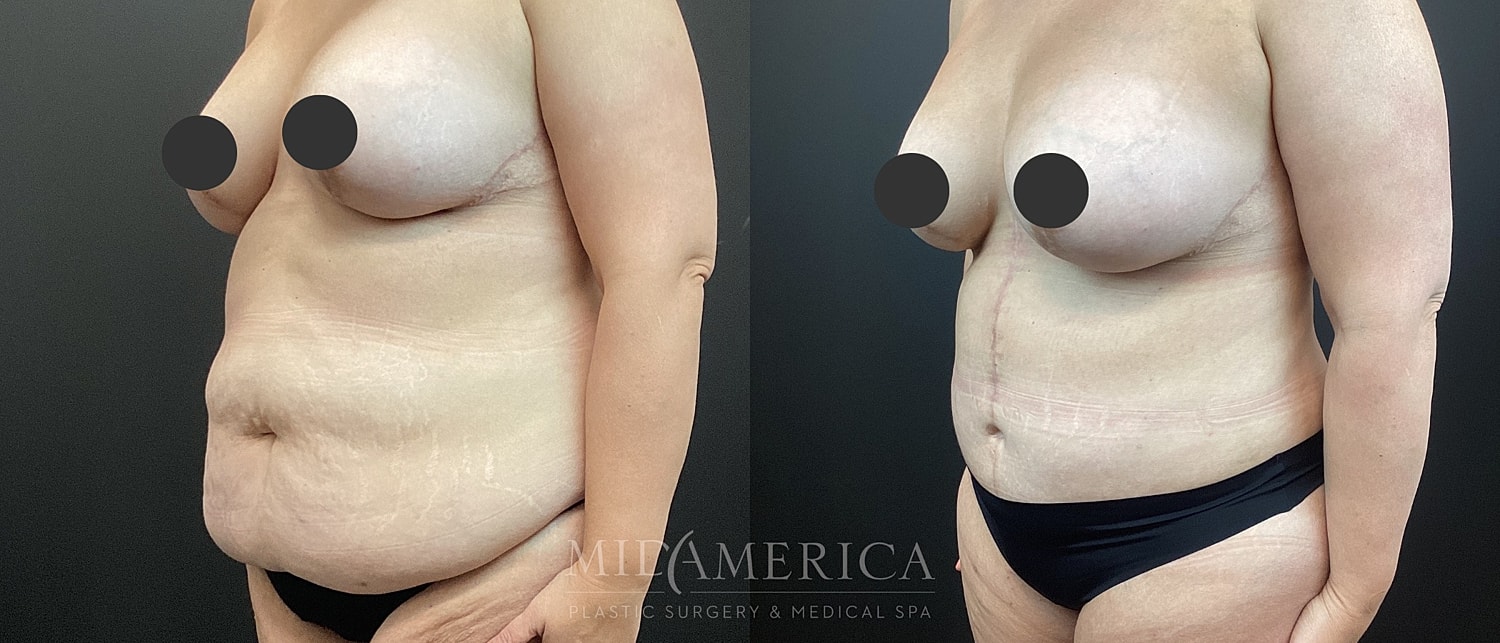 Tummy Tuck Before & After