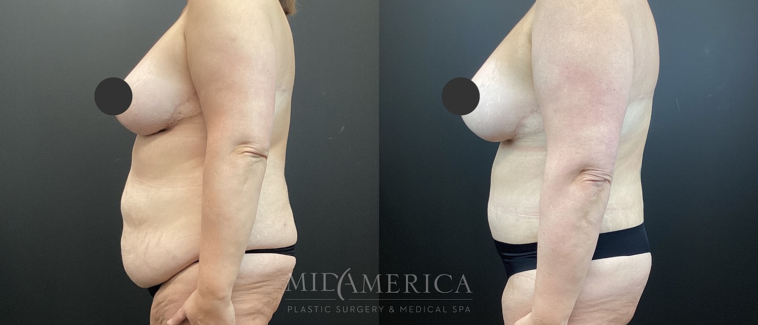 Tummy Tuck Before & After
