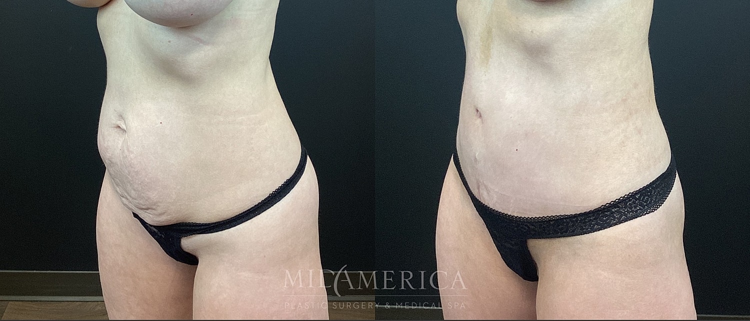Tummy Tuck Before & After