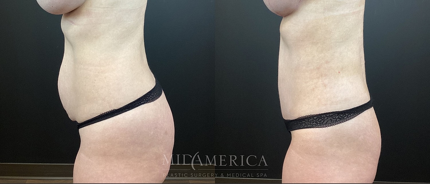 Tummy Tuck Before & After