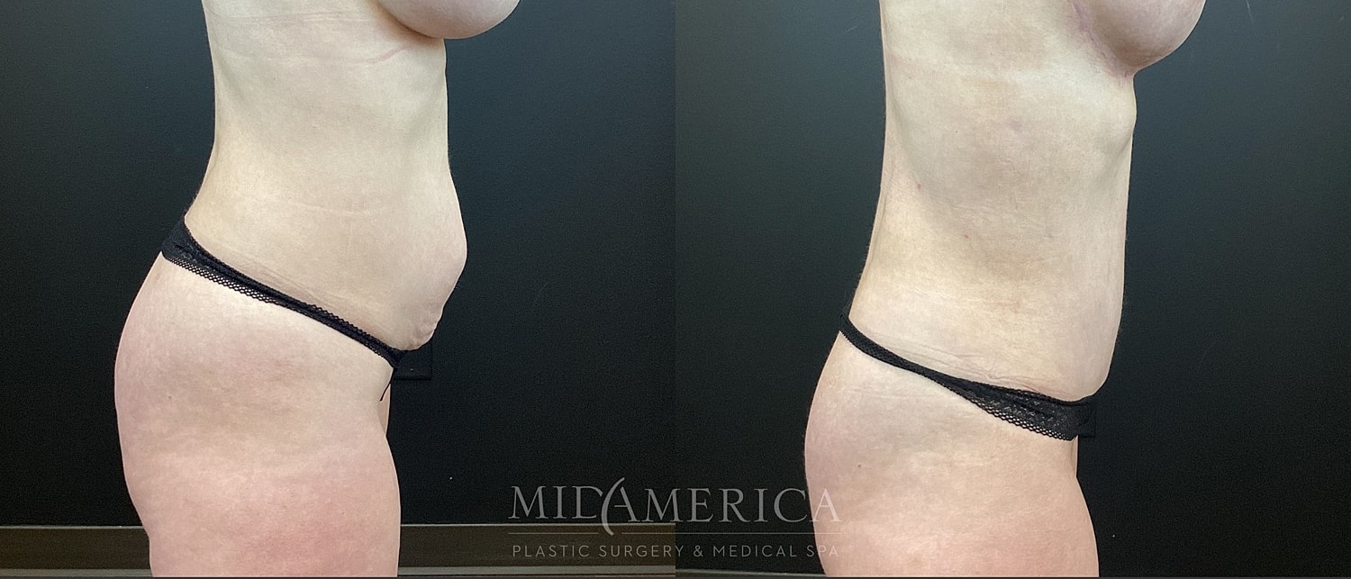 Tummy Tuck Before & After