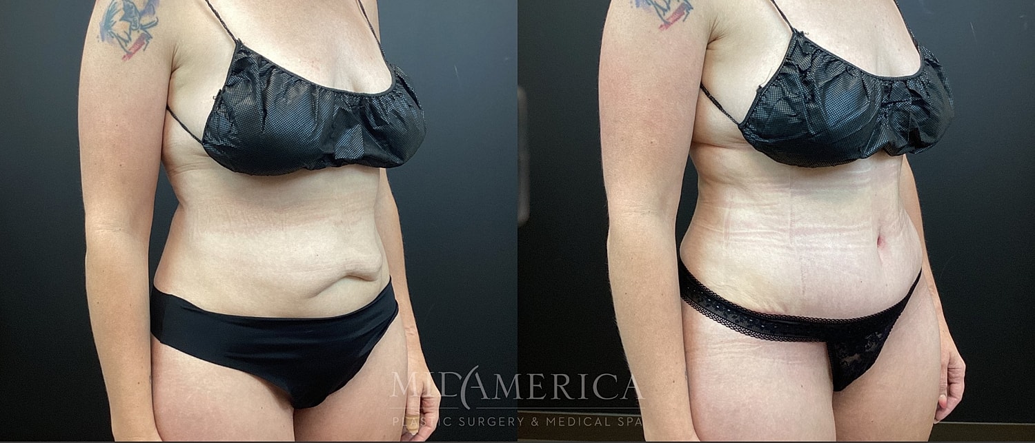 Tummy Tuck Before & After