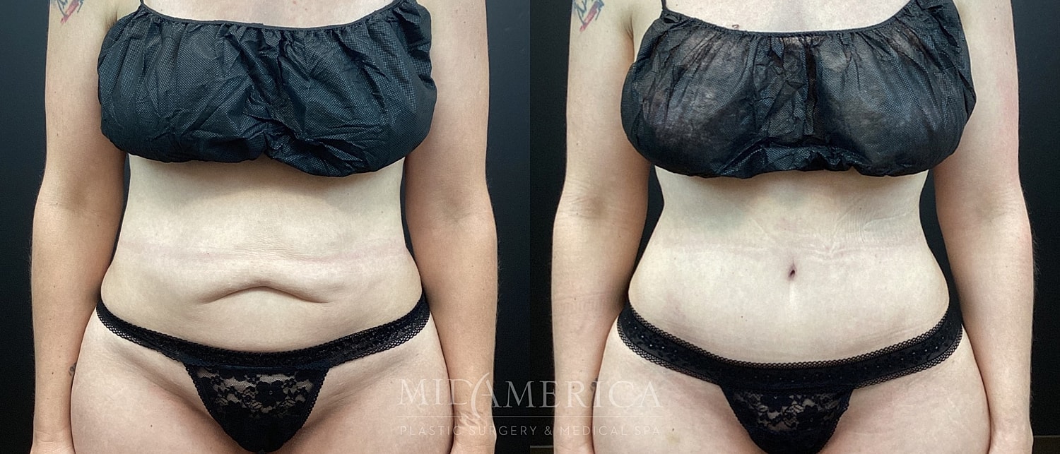 Before and after body transformation photo.