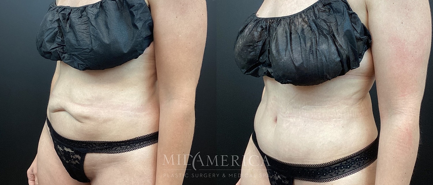 Before and after plastic surgery body comparison.
