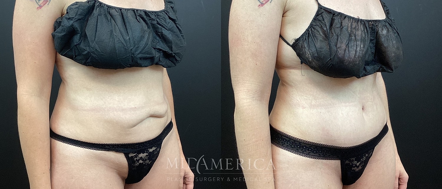 Before and after image of body contouring procedure.