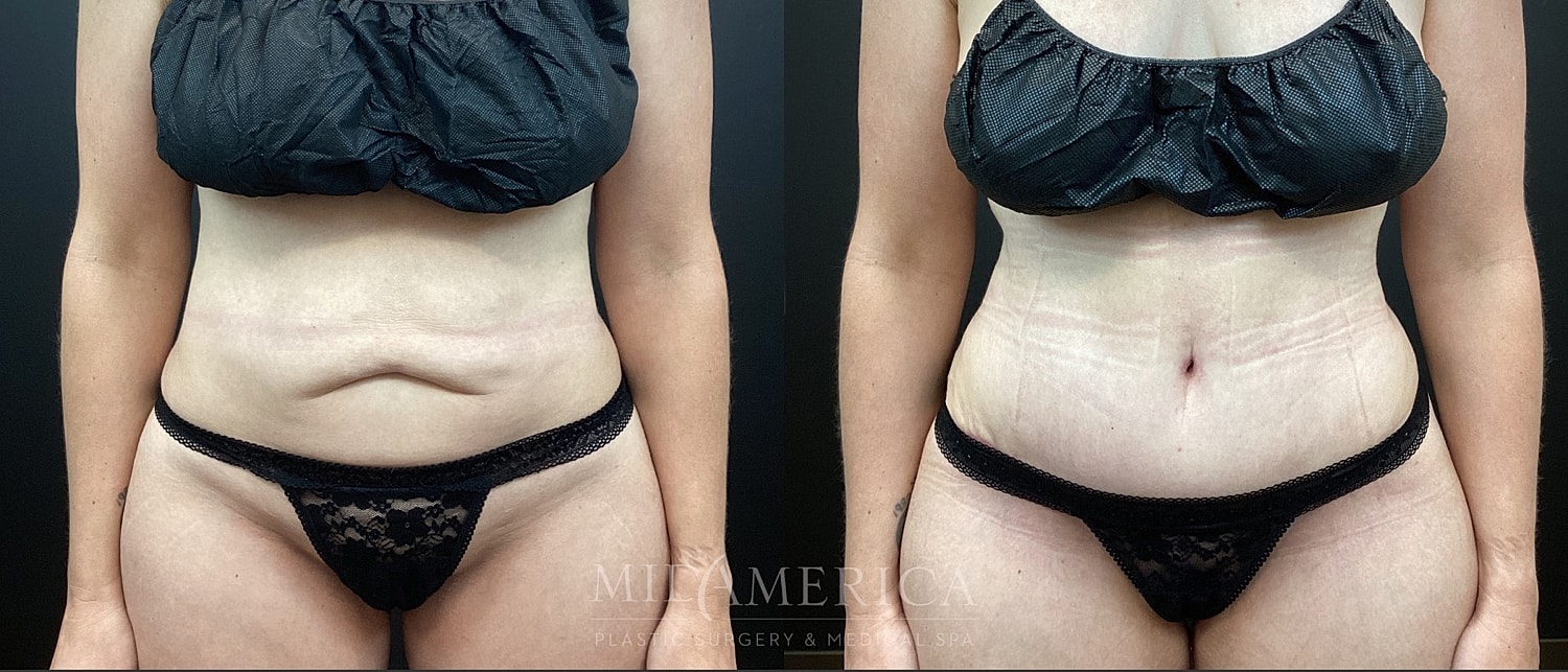 Tummy Tuck Before & After