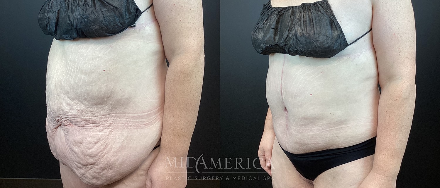 Post-surgery body contouring results side-by-side.