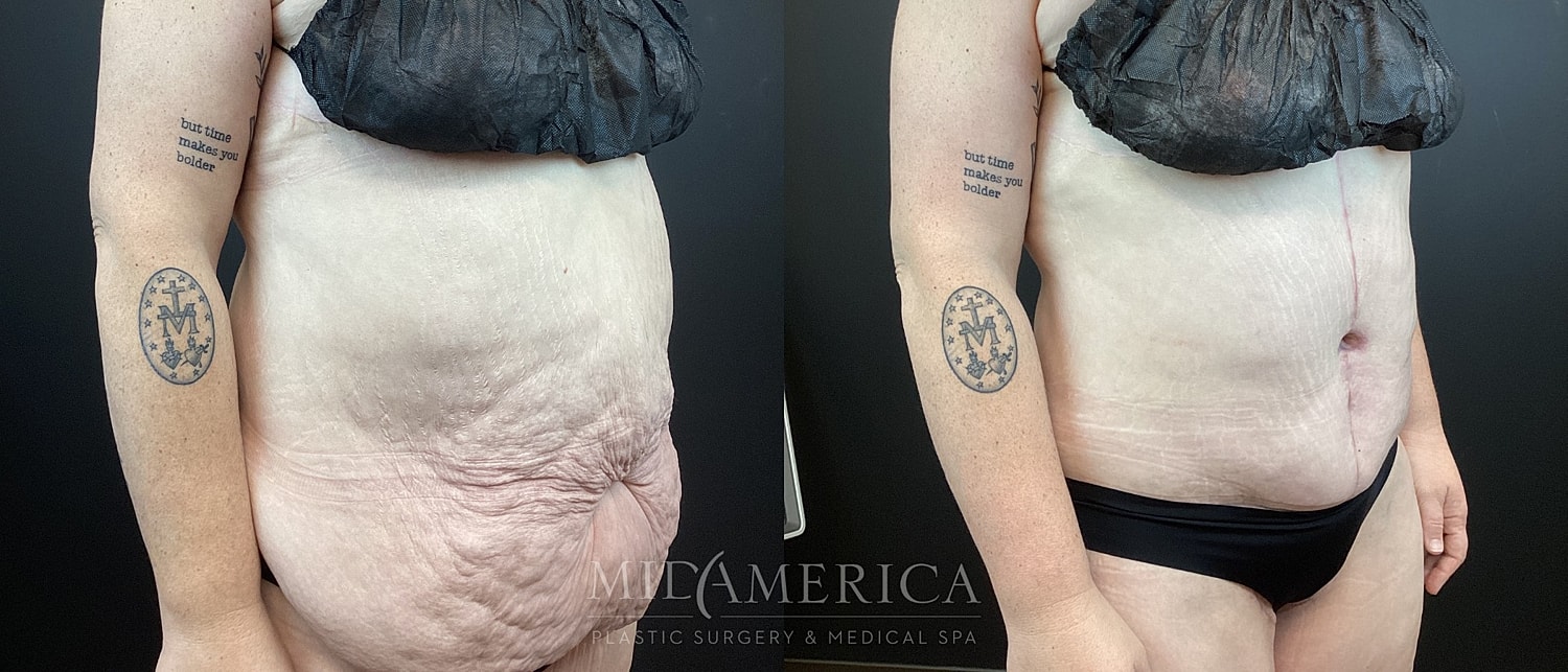 Post-surgery body transformation photos, side view.