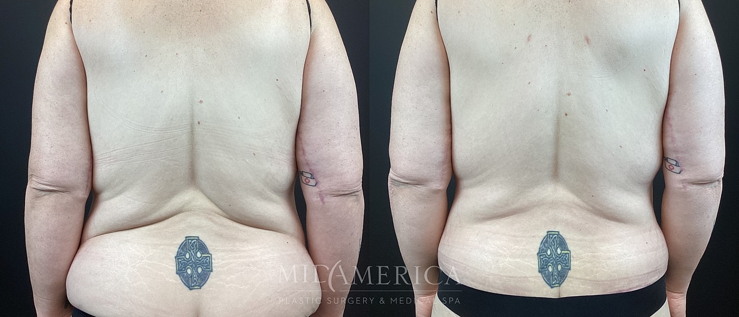 Before and after body contouring treatment comparison.