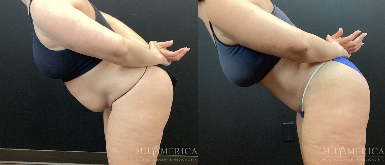 Tummy Tuck Before & After