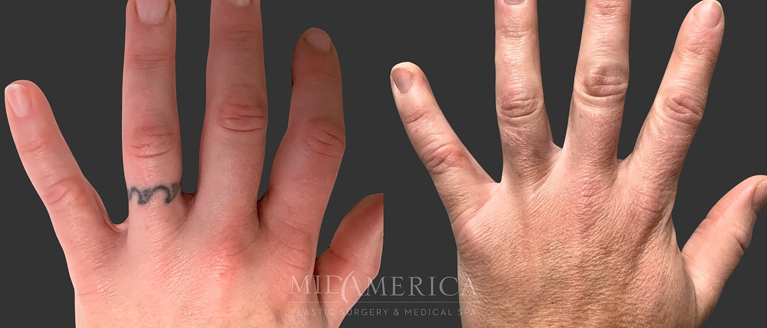 Tattoo Removal Before & After