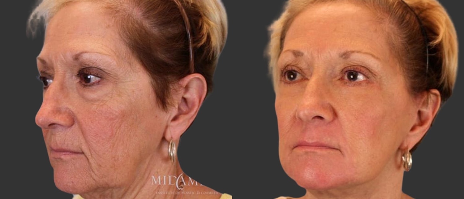 Facelift Before & After