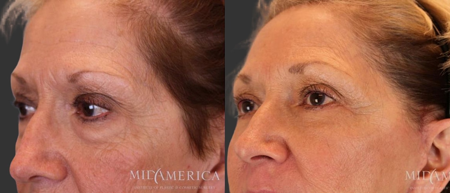 Facelift Before & After