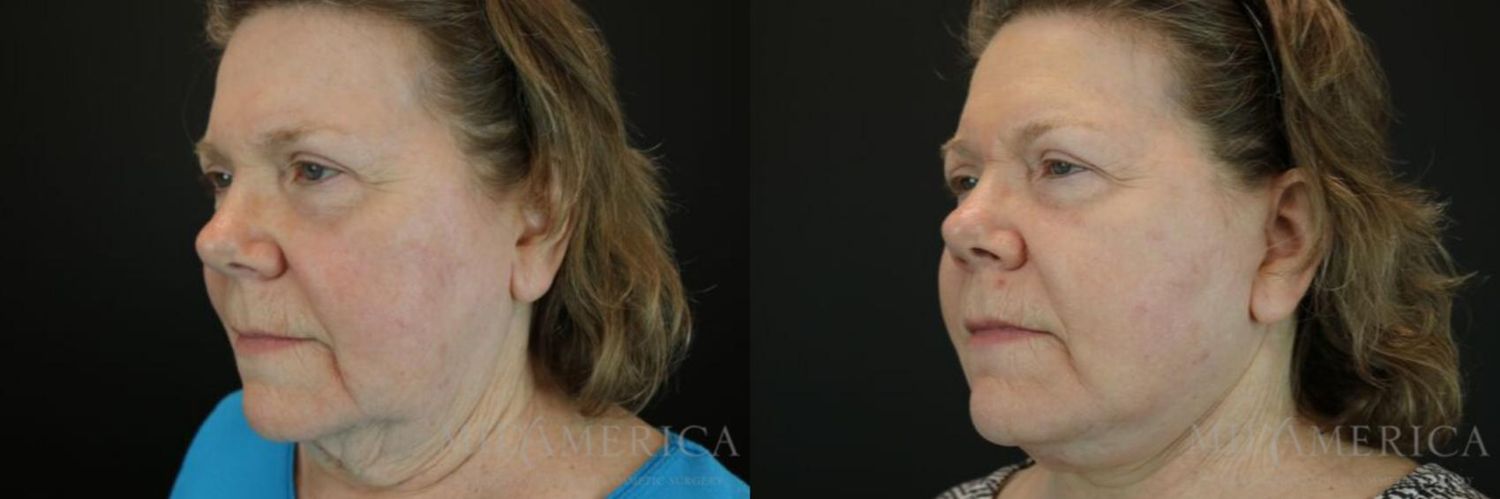 Facelift Before & After