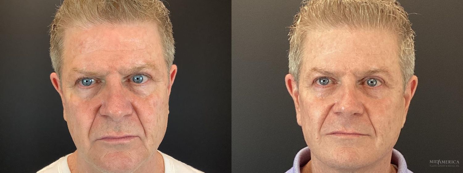 Facelift Before & After