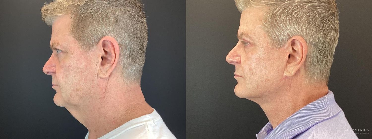 Facelift Before & After
