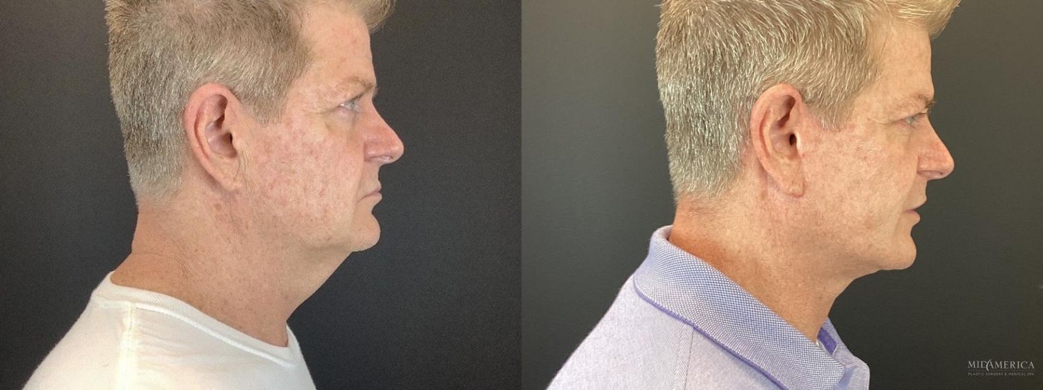 Facelift Before & After