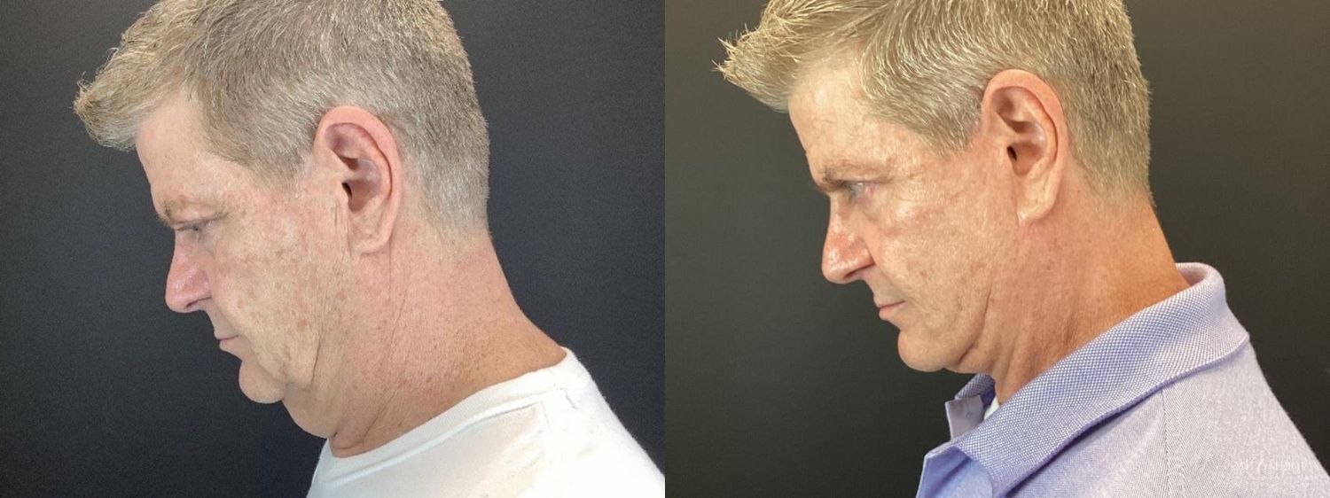 Facelift Before & After