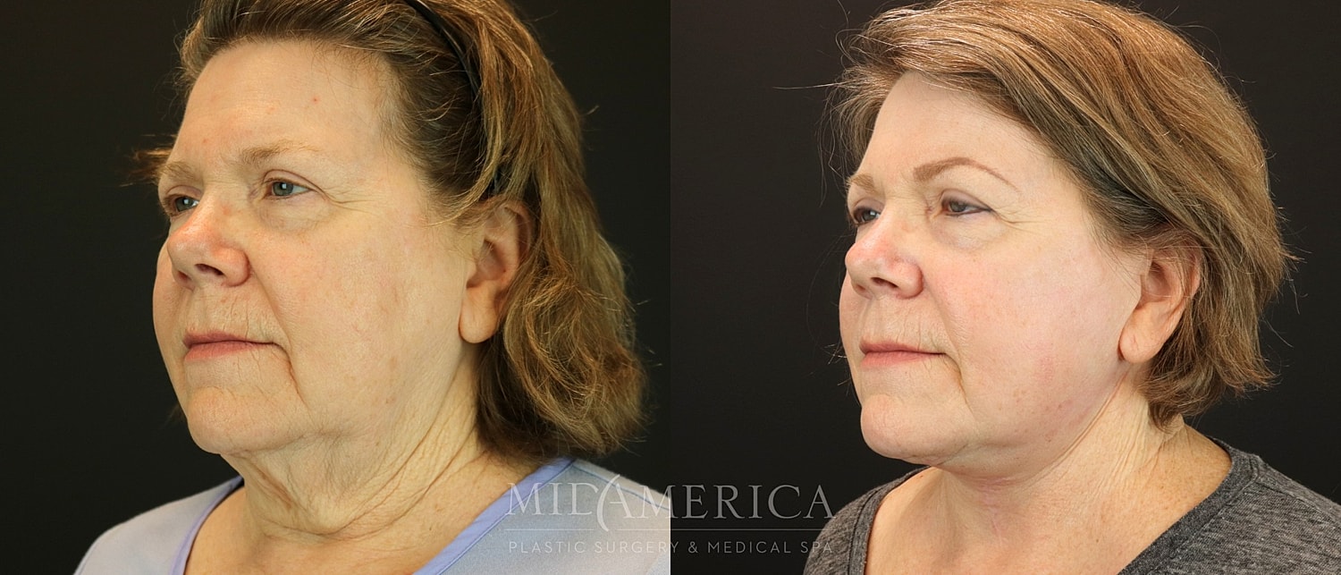 Facelift Before & After
