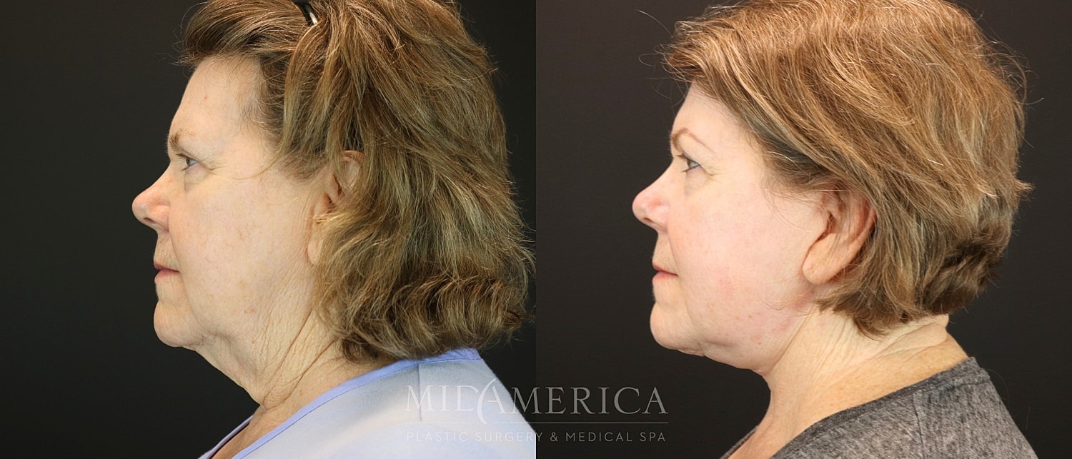 Facelift Before & After