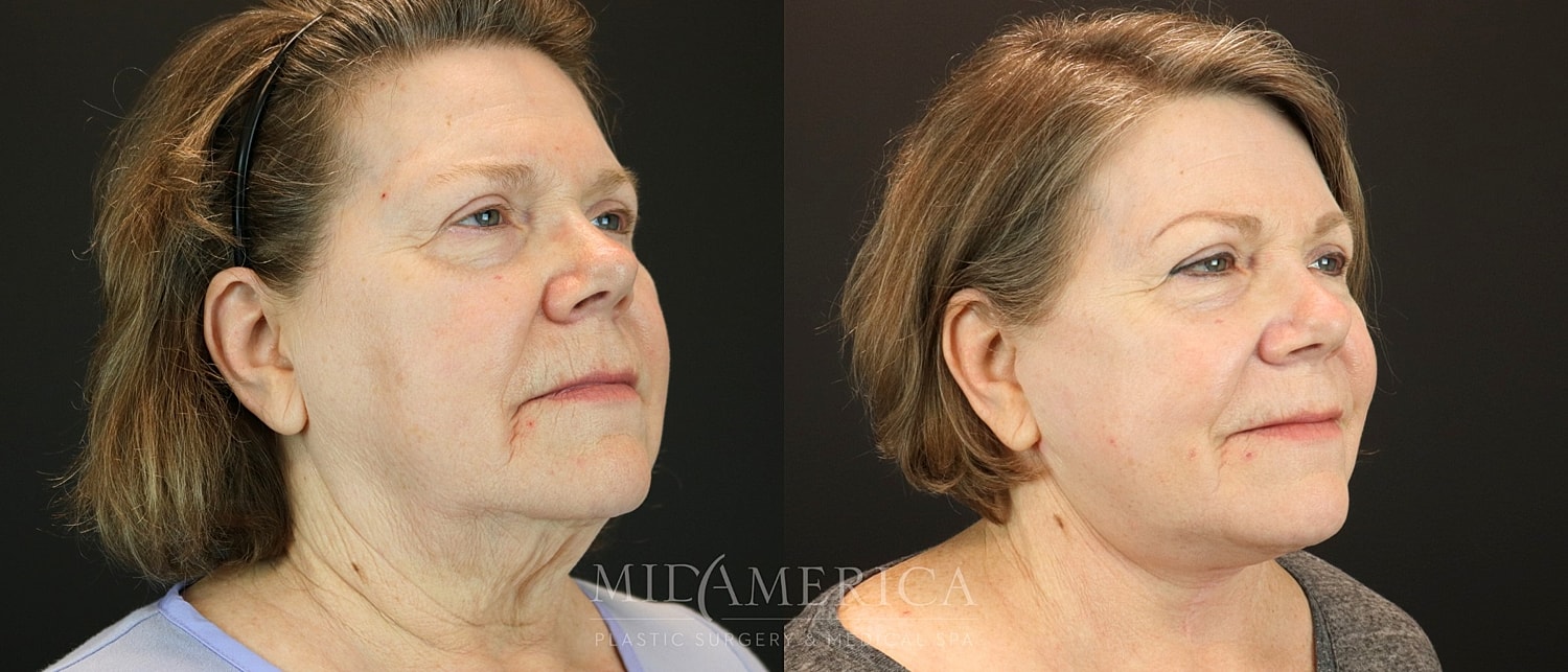 Facelift Before & After