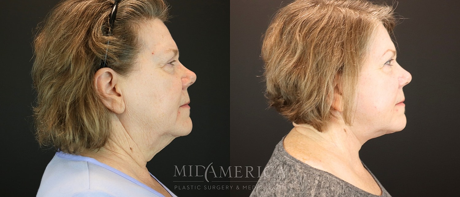 Facelift Before & After