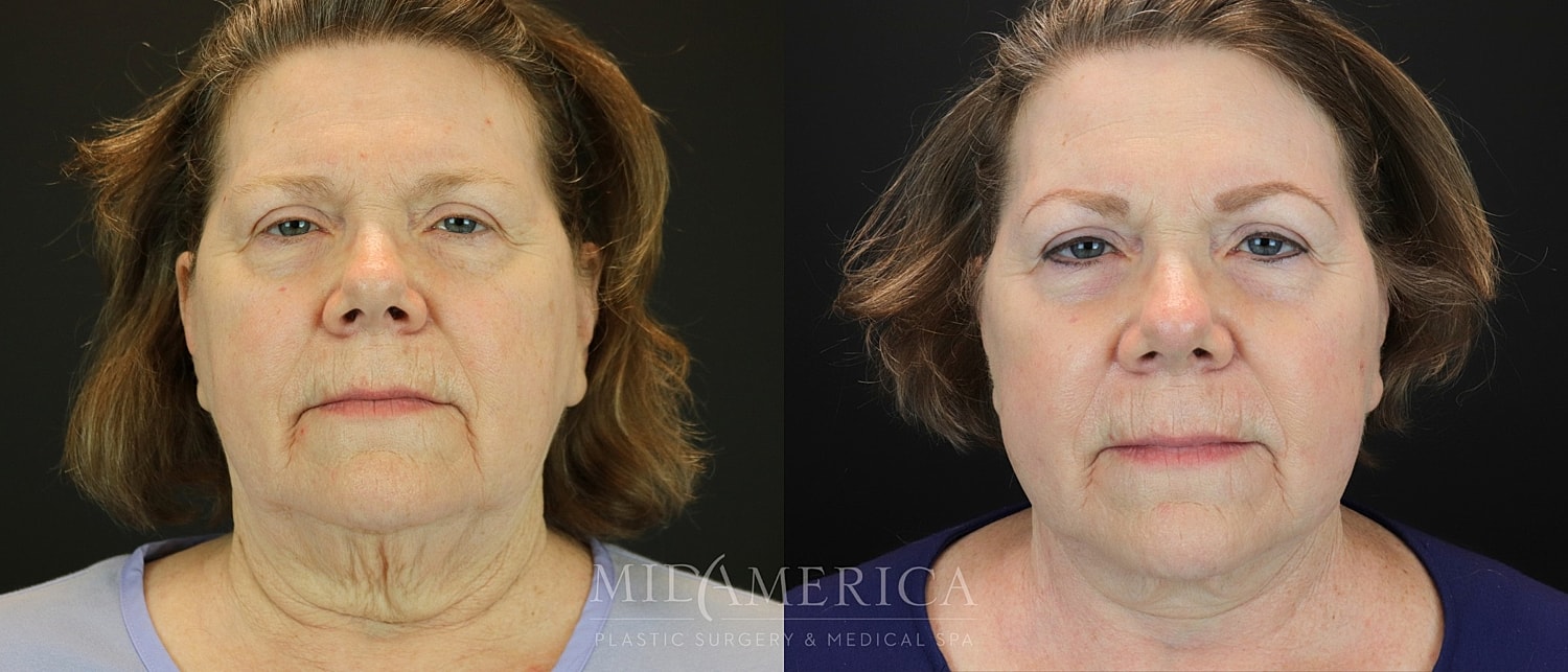 Facelift Before & After