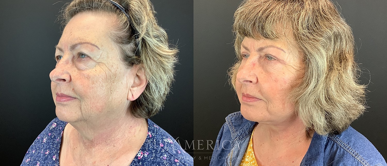 Facelift Before & After