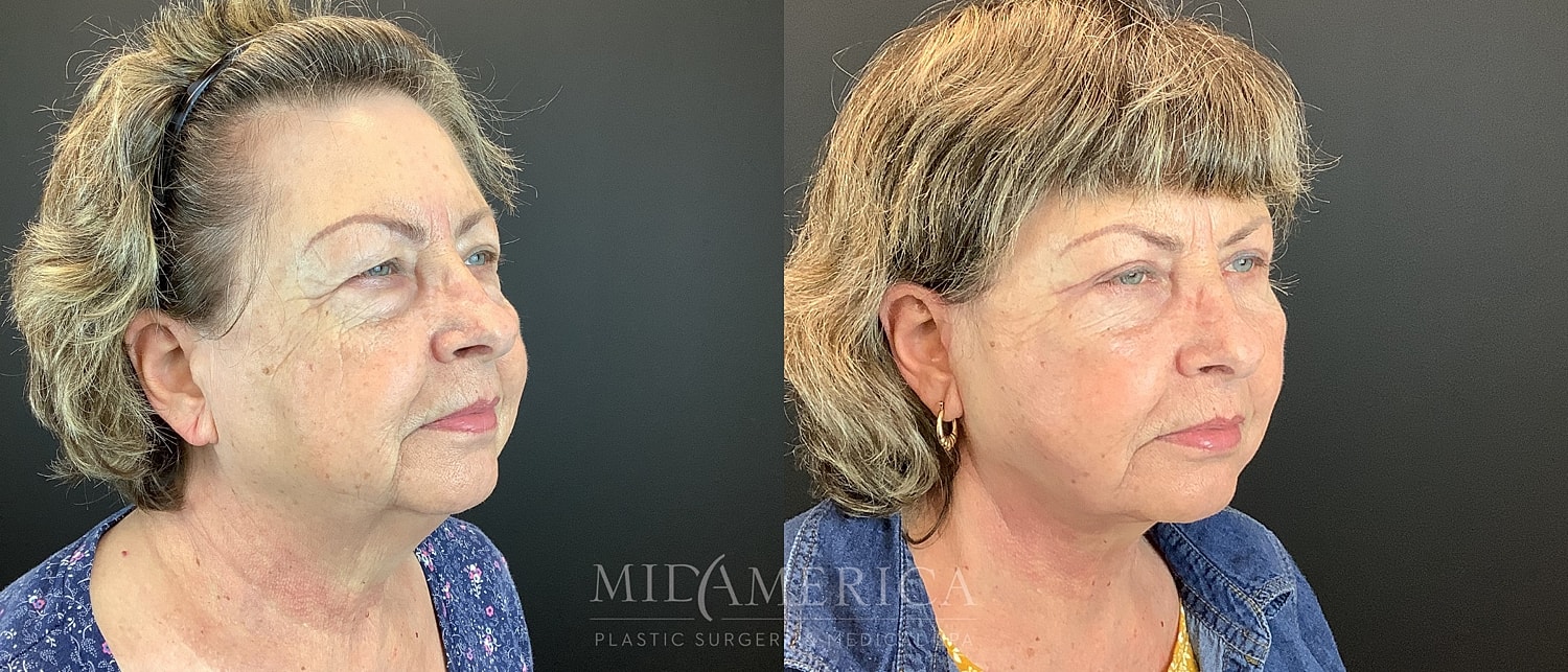 Facelift Before & After