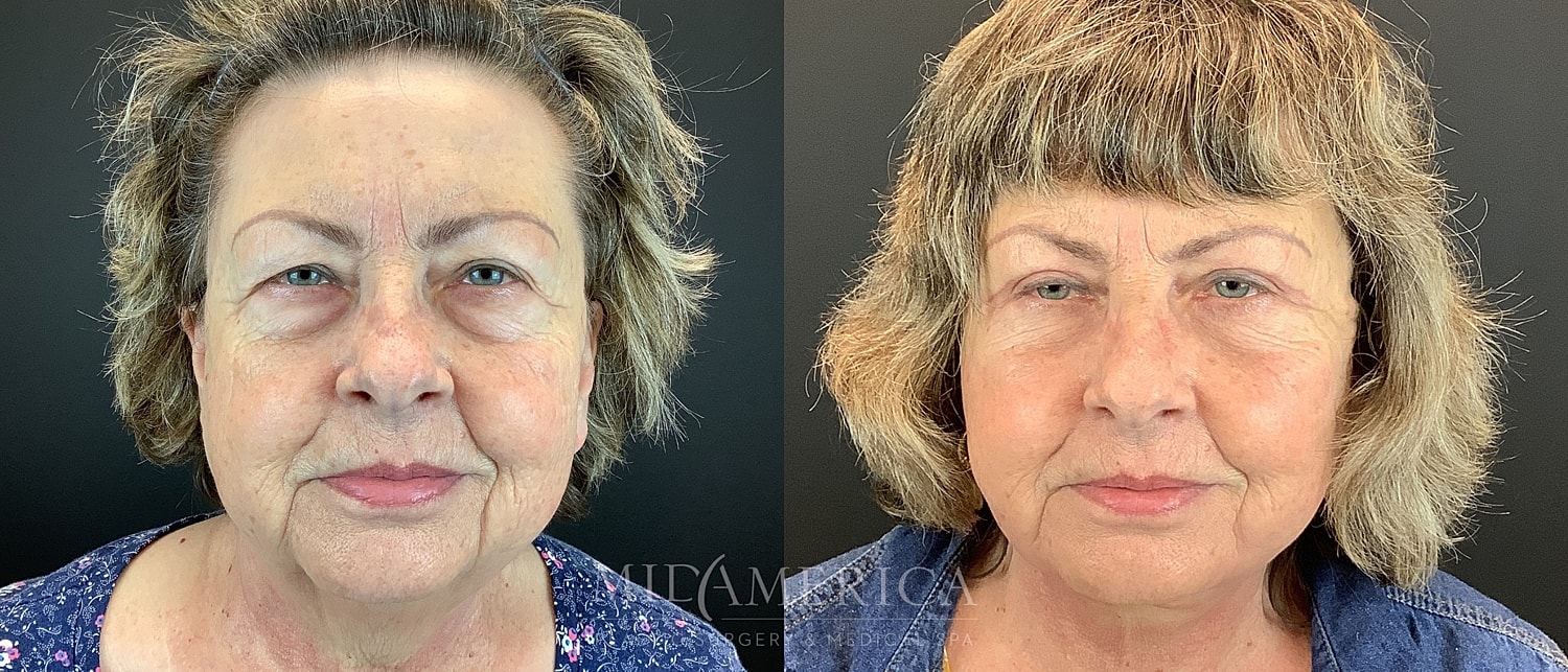 Facelift Before & After
