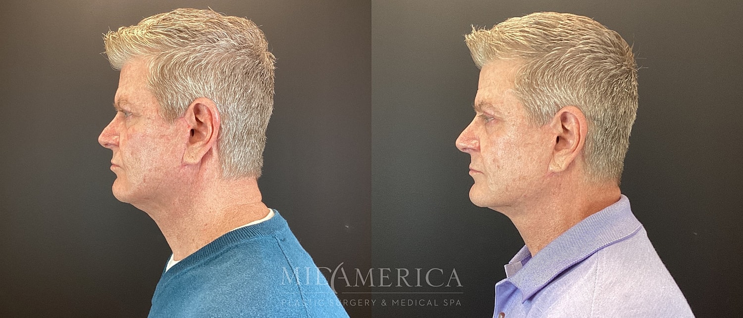 Facelift Before & After