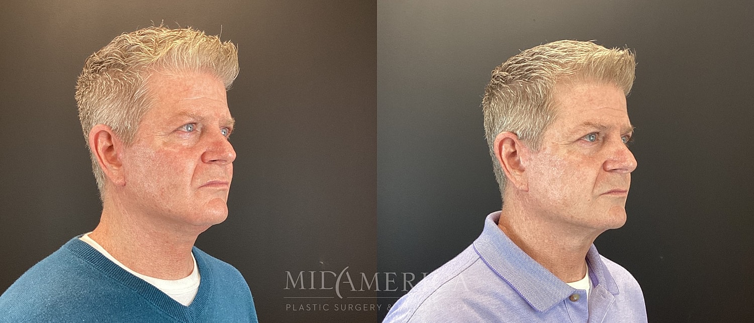 Facelift Before & After