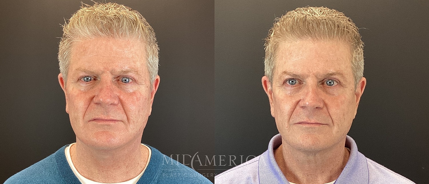 Facelift Before & After