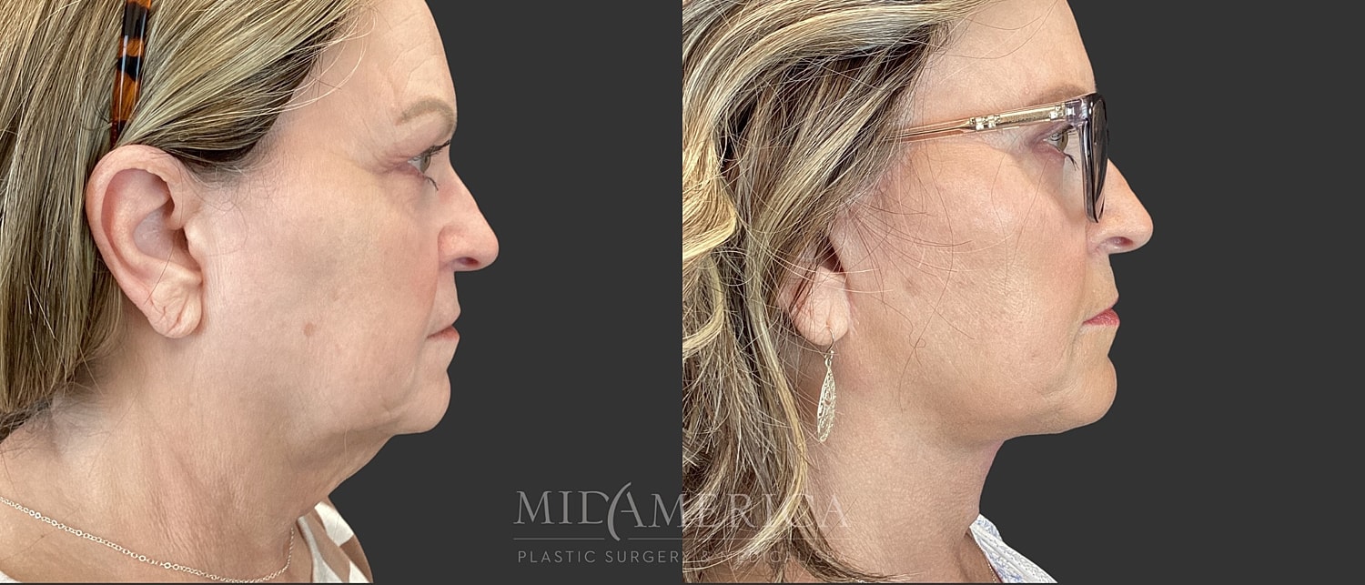 Facelift Before & After