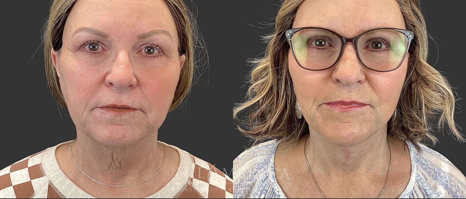 Facelift Before & After